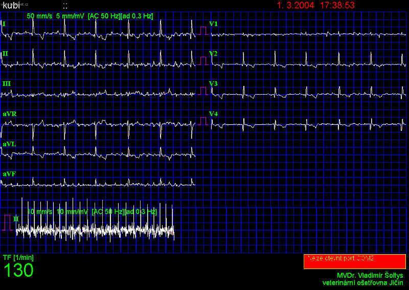 Foto: Fibrilace síní